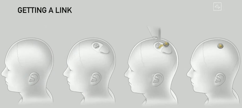 Installing Neuralink inside Human Skull